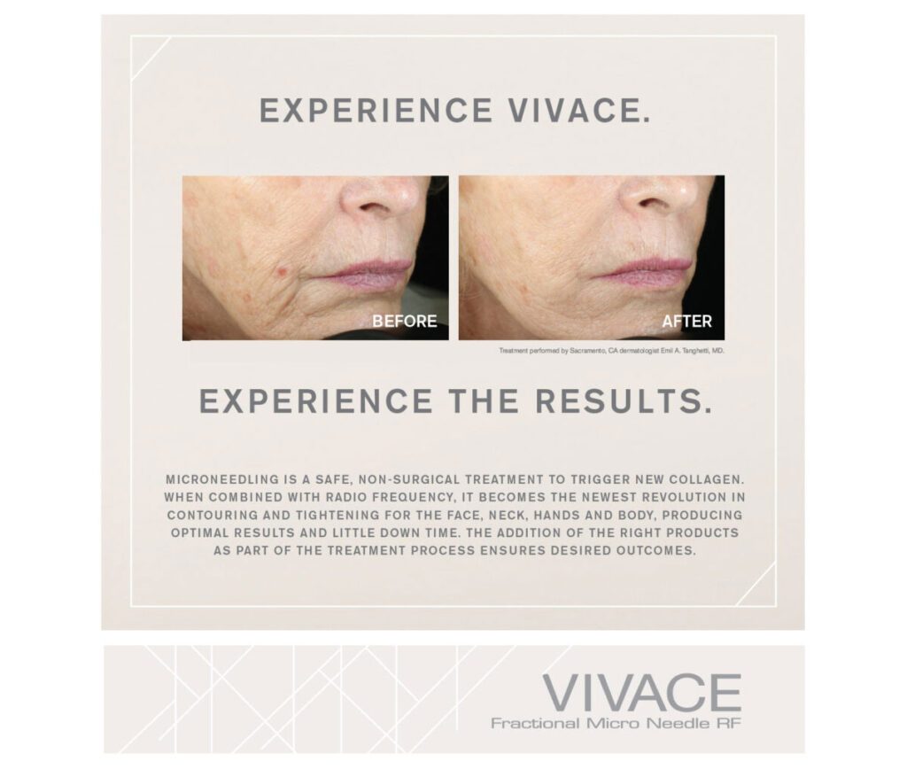 Vivace Rf Microneedling Doroderma Gr